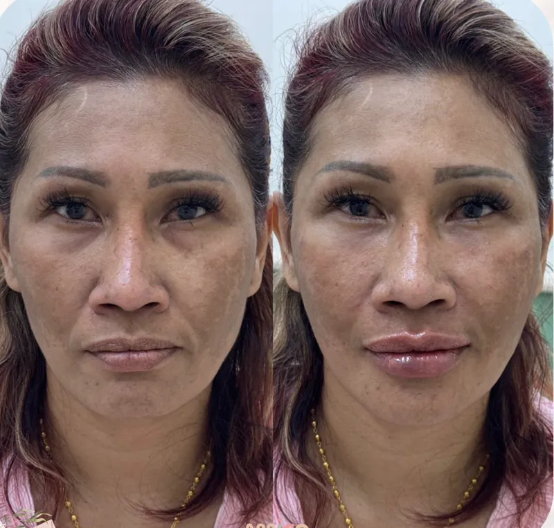 ภาพเปรียบเทียบใบหน้าก่อนและหลังฉีดฟิลเลอร์ปรับรูปหน้า ภาพซ้ายก่อนทำ ภาพขวาหลังทำ ใบหน้าดูอิ่มขึ้น