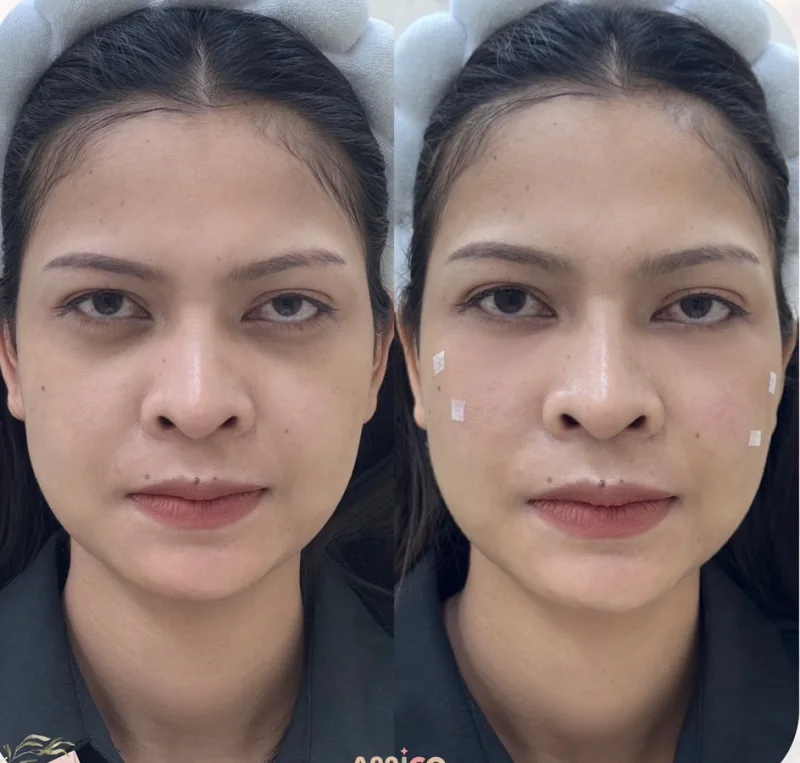 ภาพเปรียบเทียบใบหน้าก่อนและหลังฉีดฟิลเลอร์ใต้ตา ภาพซ้ายก่อนทำ ภาพขวาหลังทำ ใต้ตาดูตื้นขึ้นและสว่างขึ้น